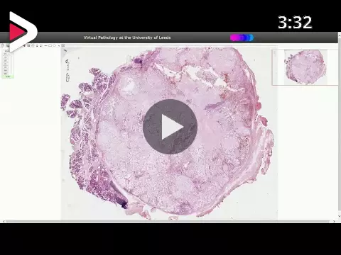 Pleomorphic Adenoma Histopathology Dideo